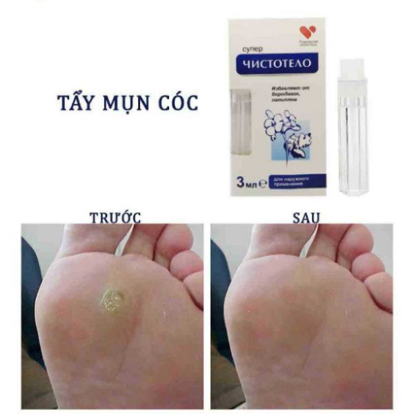 Gel tẩy nốt ruồi mụn cơm mụn cóc
