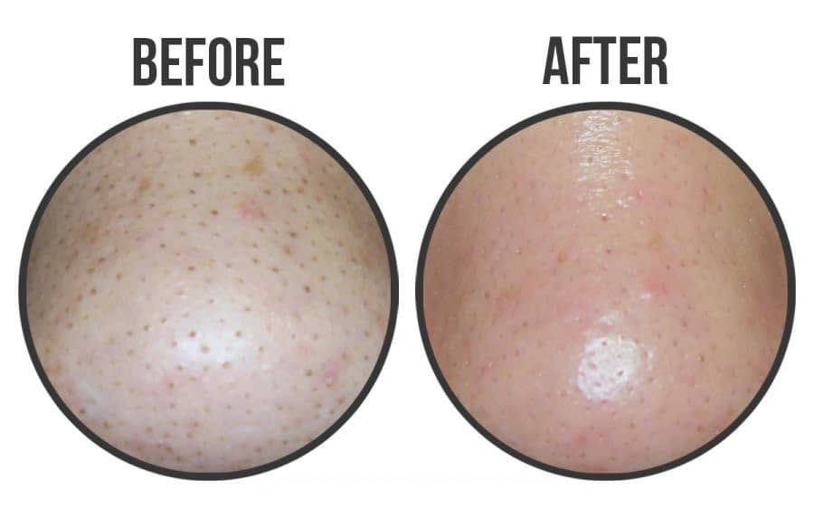 Miếng dán mụn đầu đen Ciracle GOODBYE BLACKHEAD