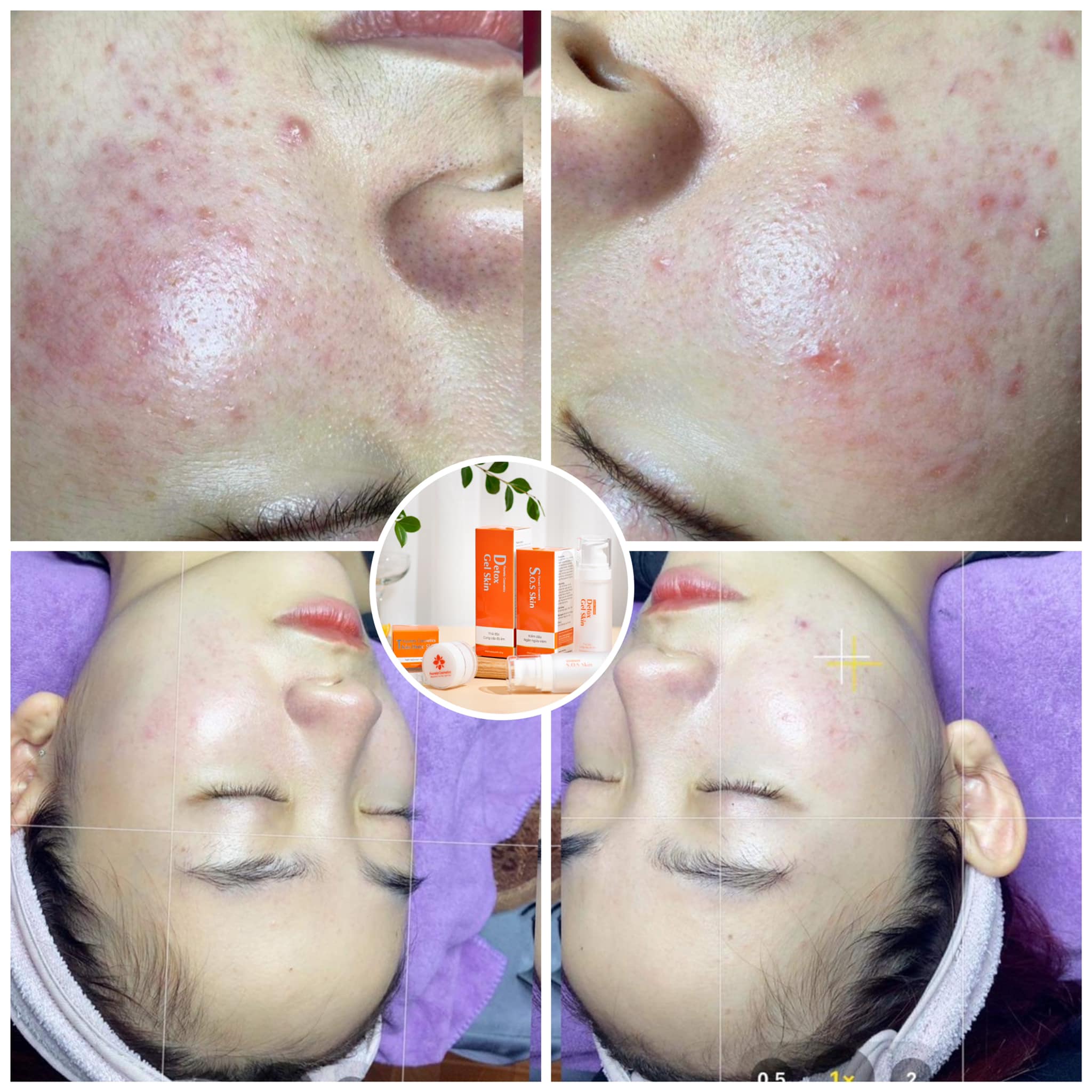 Cao Mụn Cure Medicine-Fourets