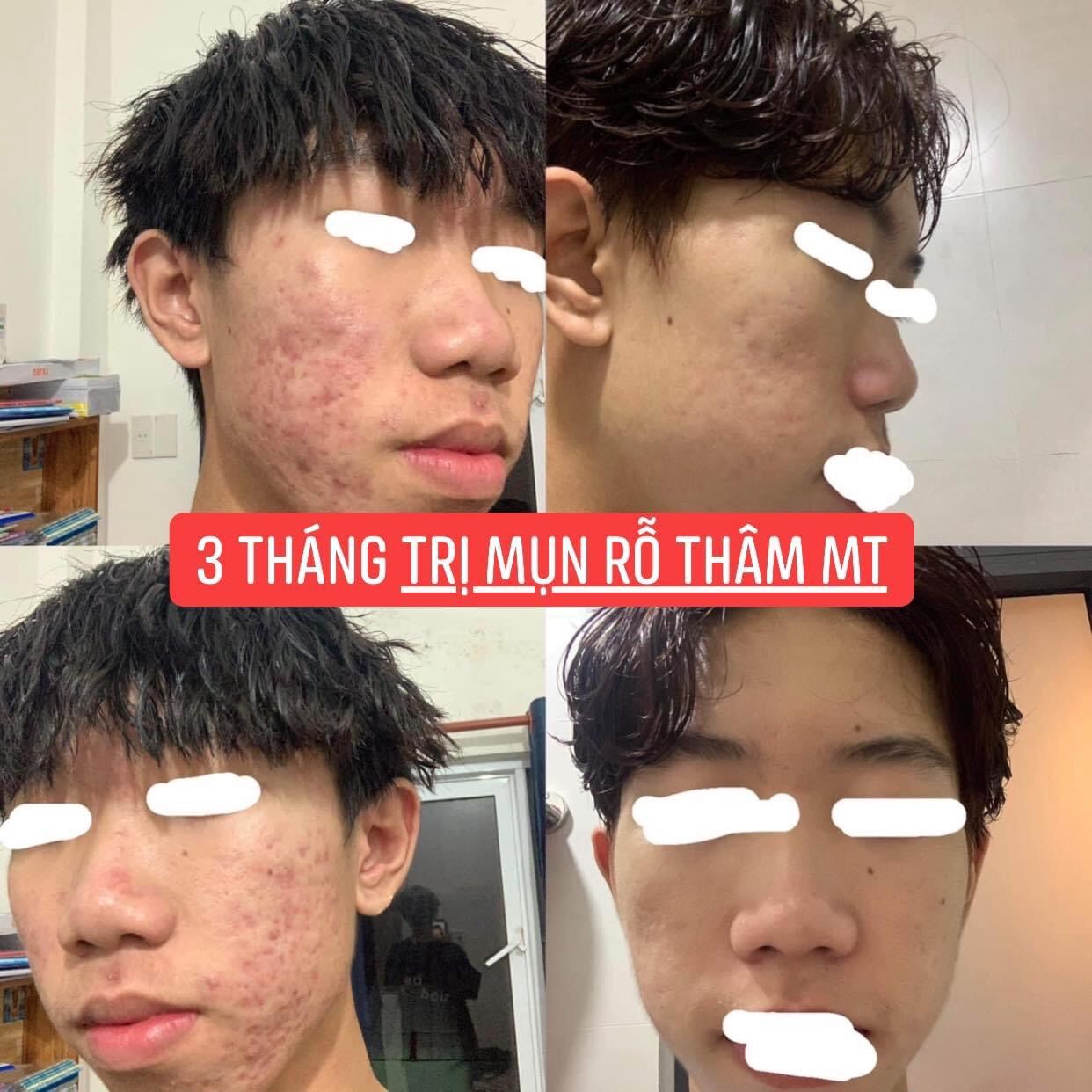 ( 2 lọ )Thảo Dược Sạch Mụn Thâm Rỗ MT (50ml)