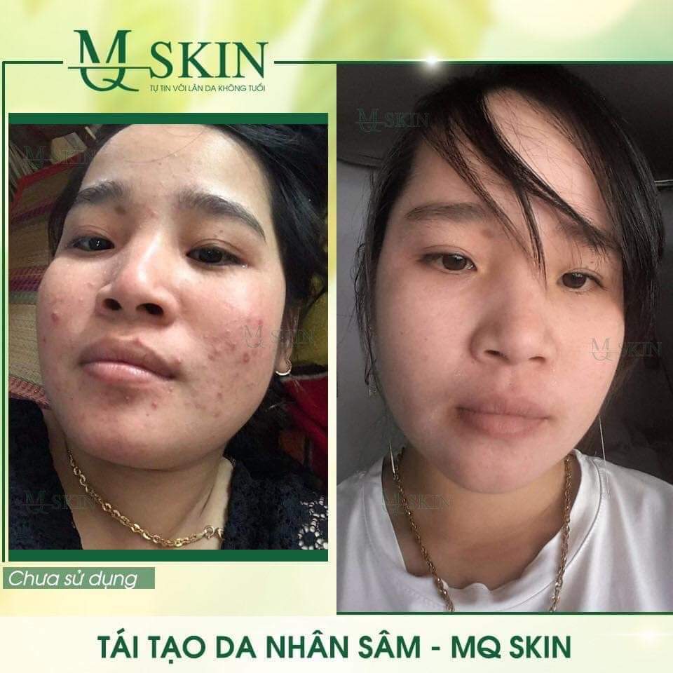 [HCM]Thay da Nhân Sâm MQSKIN