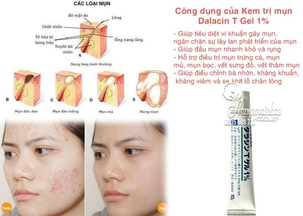 Kem Trị Mụn Dalacin T Gel 1% Nhật Bản