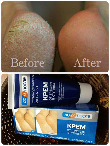 [HCM]Kem Trị Nứt Gót Chân Hàng Nga