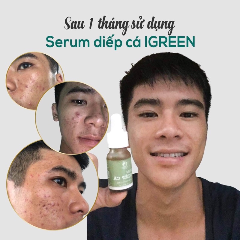 Serum Diếp Cá