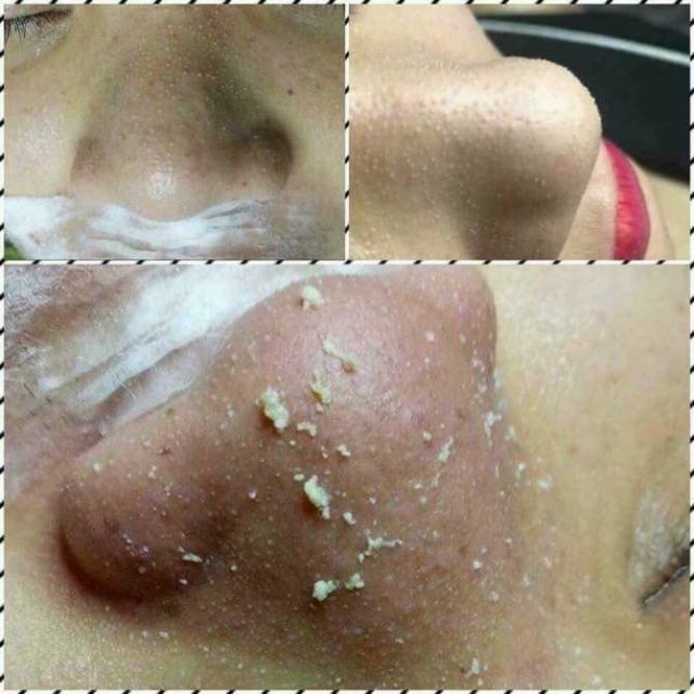 Ủ Mụn Cám Mụn Đầu Đen Hàn Quốc