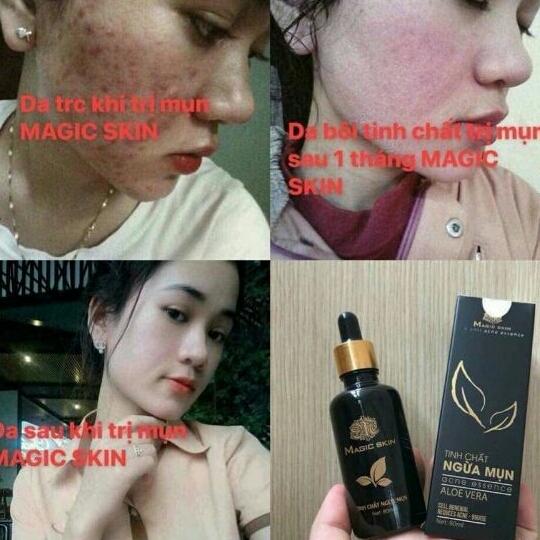 TINH CHÂT NGỪA MỤN ĐÔNG Y MAGIC SKIN