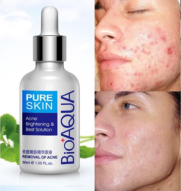 Tinh Chất BIOAQUA Xóa Mụn Mờ Thâm sẹo 30ml