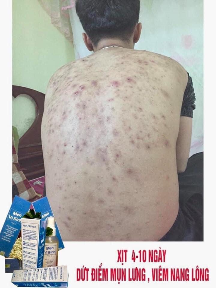 Mụn Lưng Mụn Ngực Men Vi Sinh Tavida