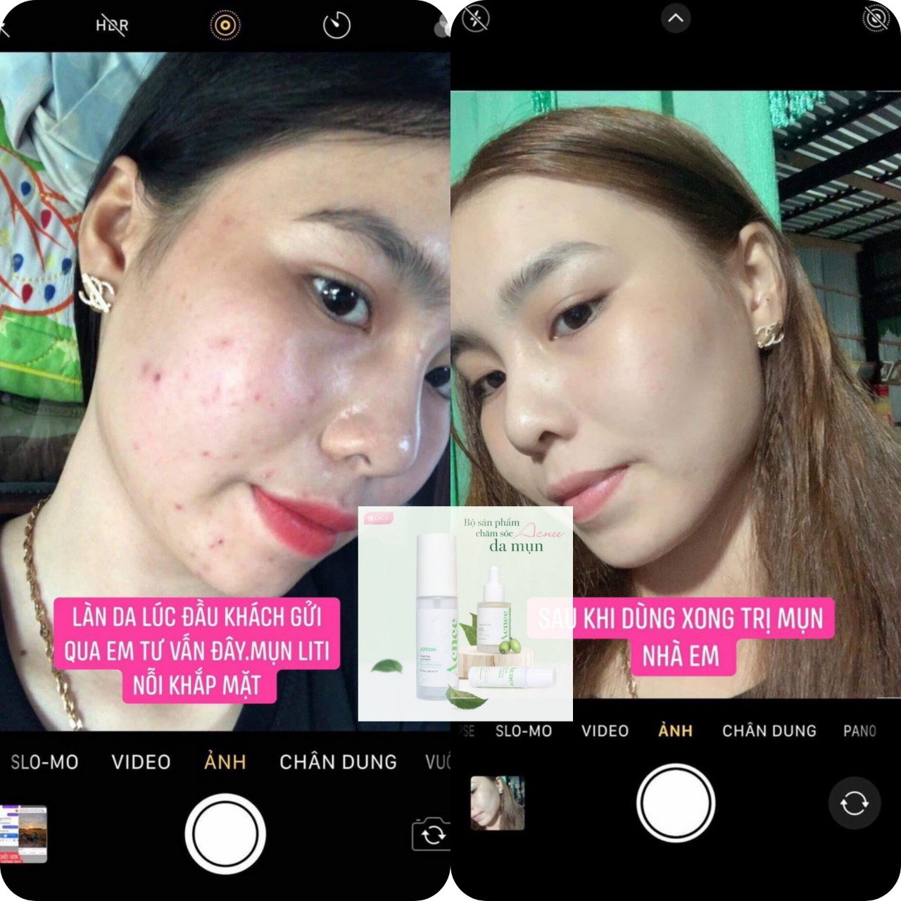 Trị Mụn Laco - bộ 3 Trị Mụn Laco [Tặng Sữa Rửa mặt]