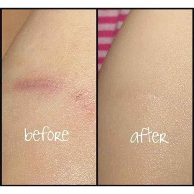 Kem ngừa sẹo Gentacin của Nhật