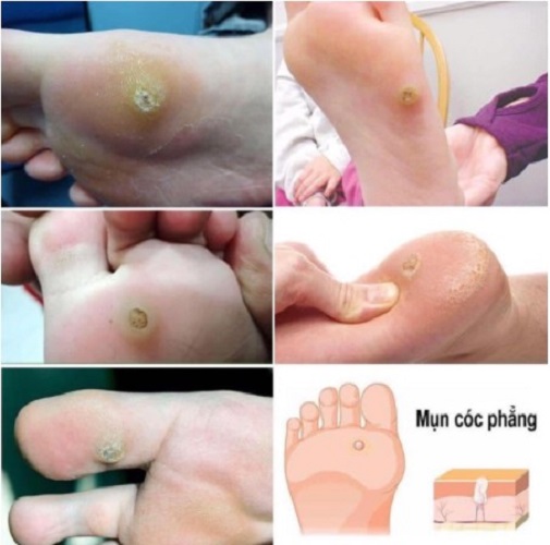 Miếng dán mụn cóc CompoundW - Mỹ