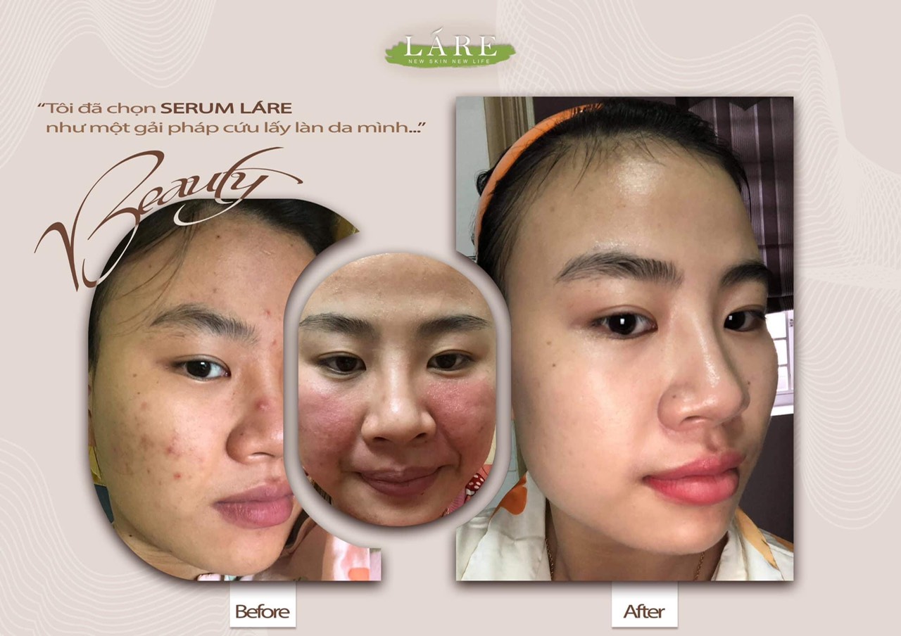 Serum Thảo mộc Thanh Dược Lare chiết lẻ 20ml