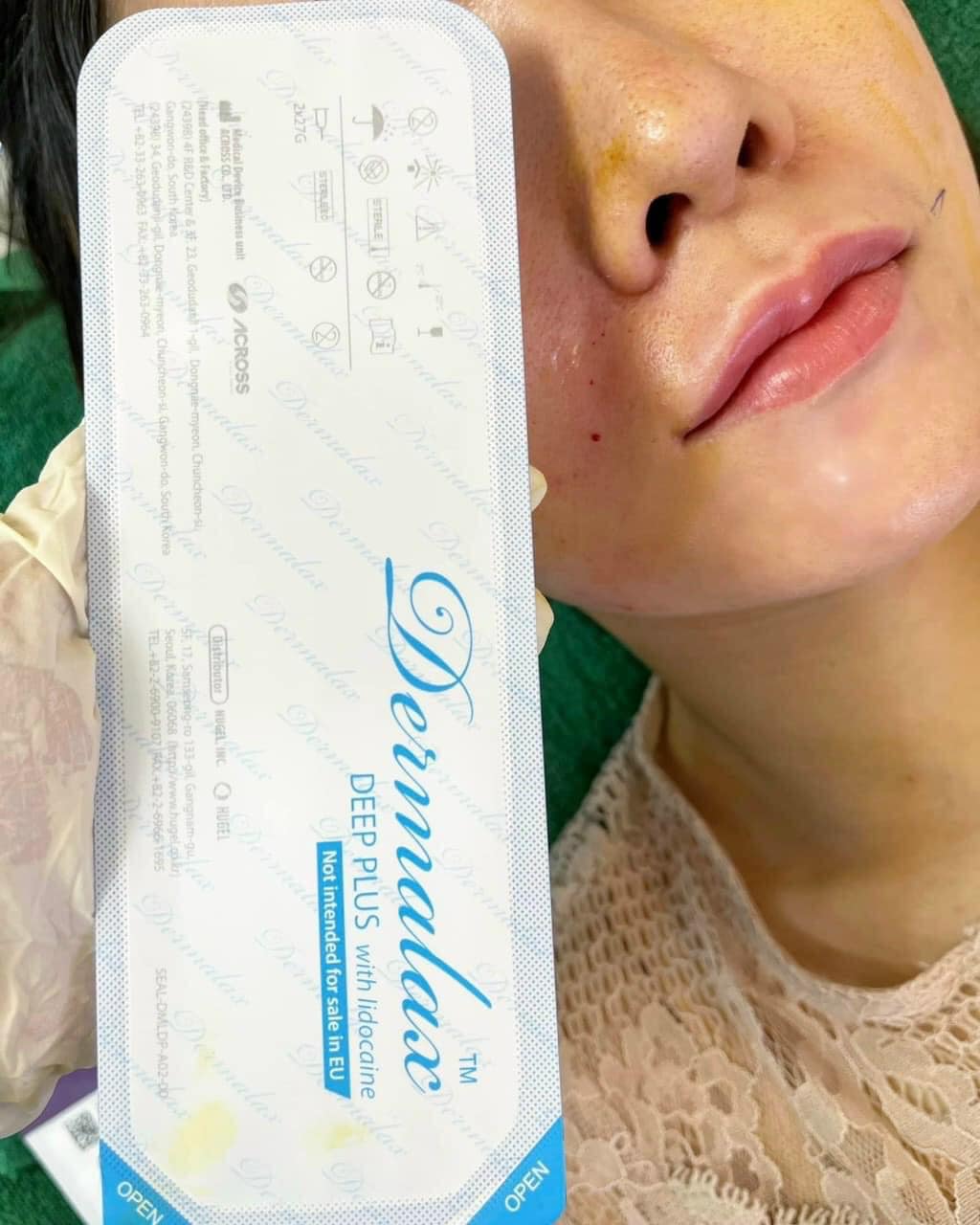 Filler Dermalax  Hàn Quốc