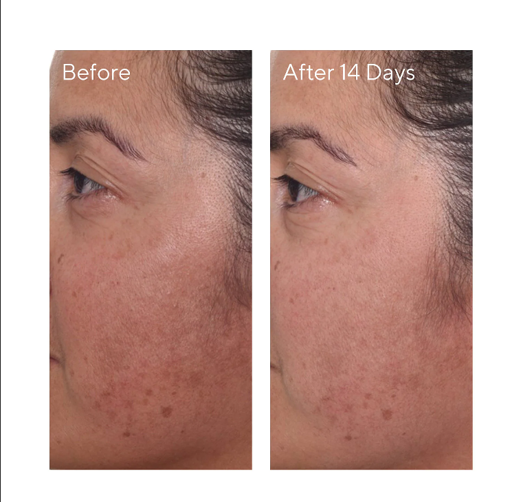 Tinh chất giảm thâm nám Murad Rapid Dark Spot Correcting Serum 30ml