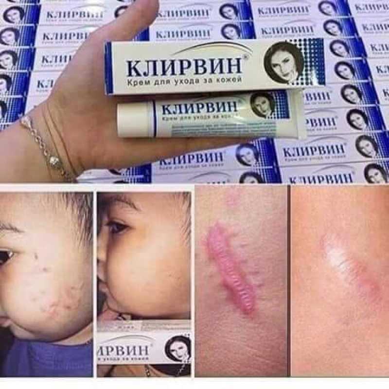 Kem tri. sẹo KJINPBNH Nga giá rẻ