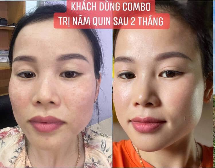 KEM TRỊ NÁM QUIN CAO CẤP