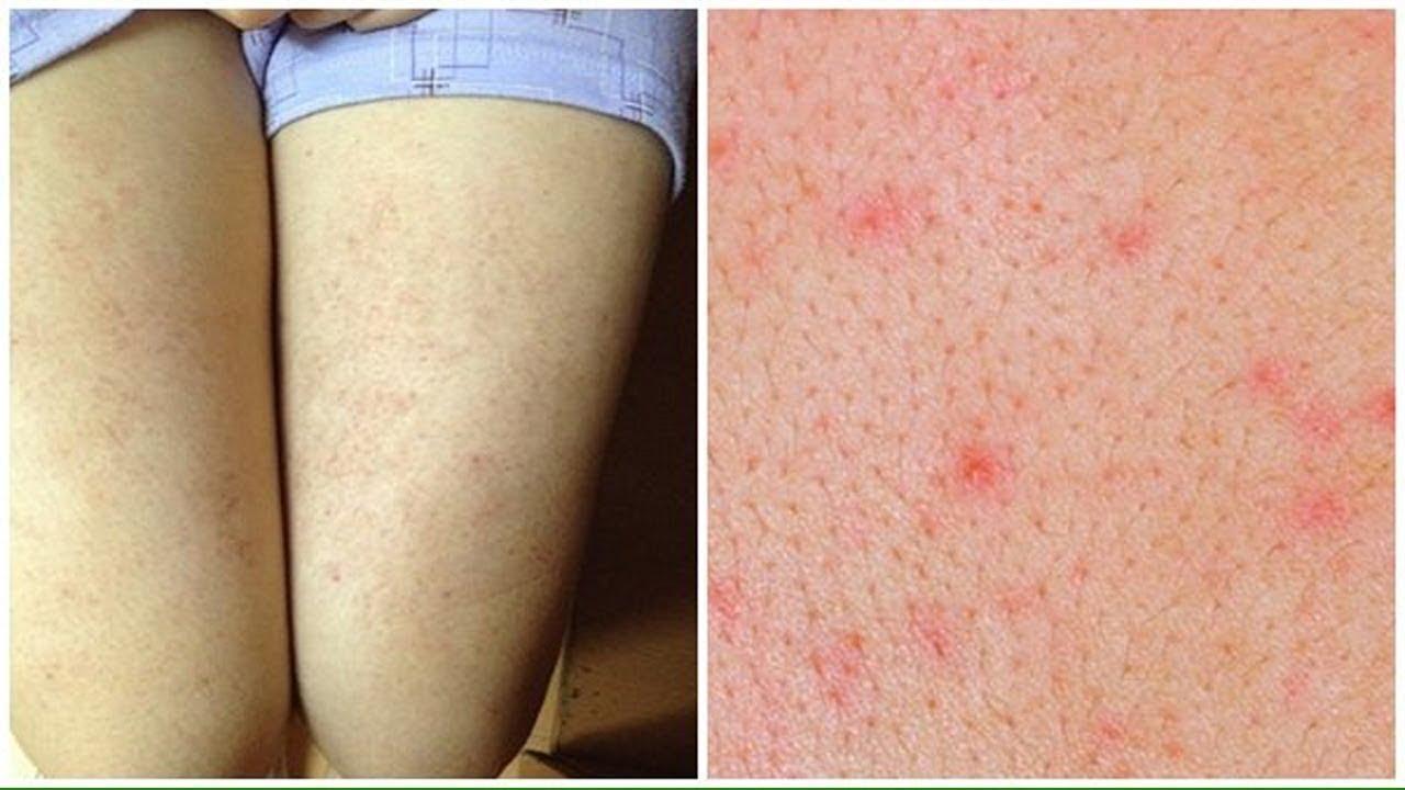 Kela Lotion Thoa Trị Viêm Nang Chân Lông 60ml