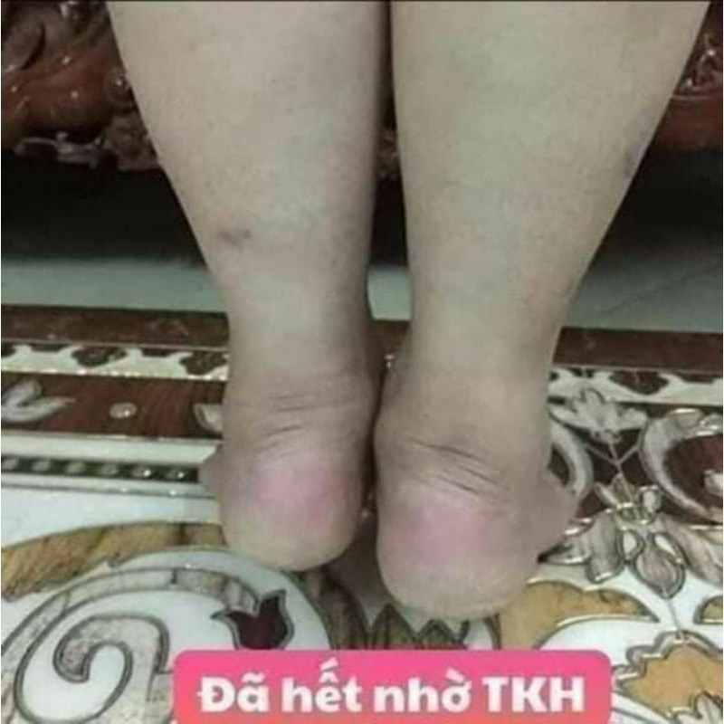 THẢO MỘC BÔI DA THIÊN NHIÊN TKH