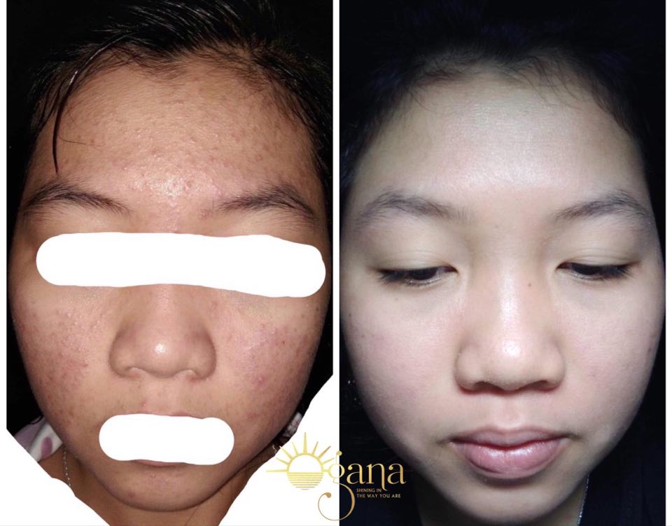 [HCM]SERUM OGANA TRỊ MỤN