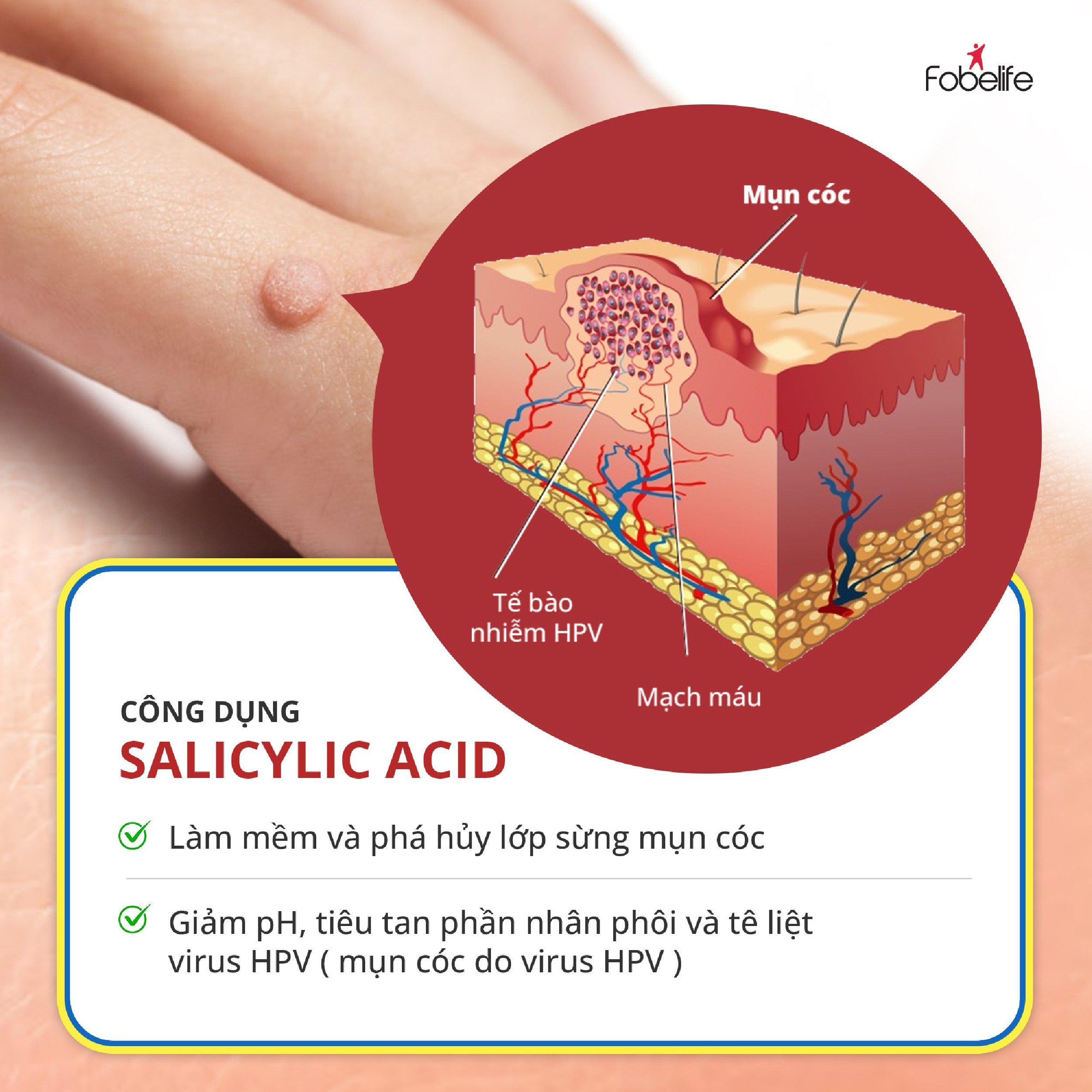 Miếng Dán Mụn Cóc Mụn Cơm Corn plaster KangDi Fobe - hộp 6 miếng