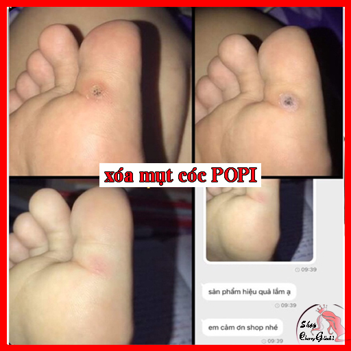 KEM TẨY MỤN CƠM, MỤN CÓC, NỐT RUỒI, MỤN THỊT, TÀN NHANG POPI