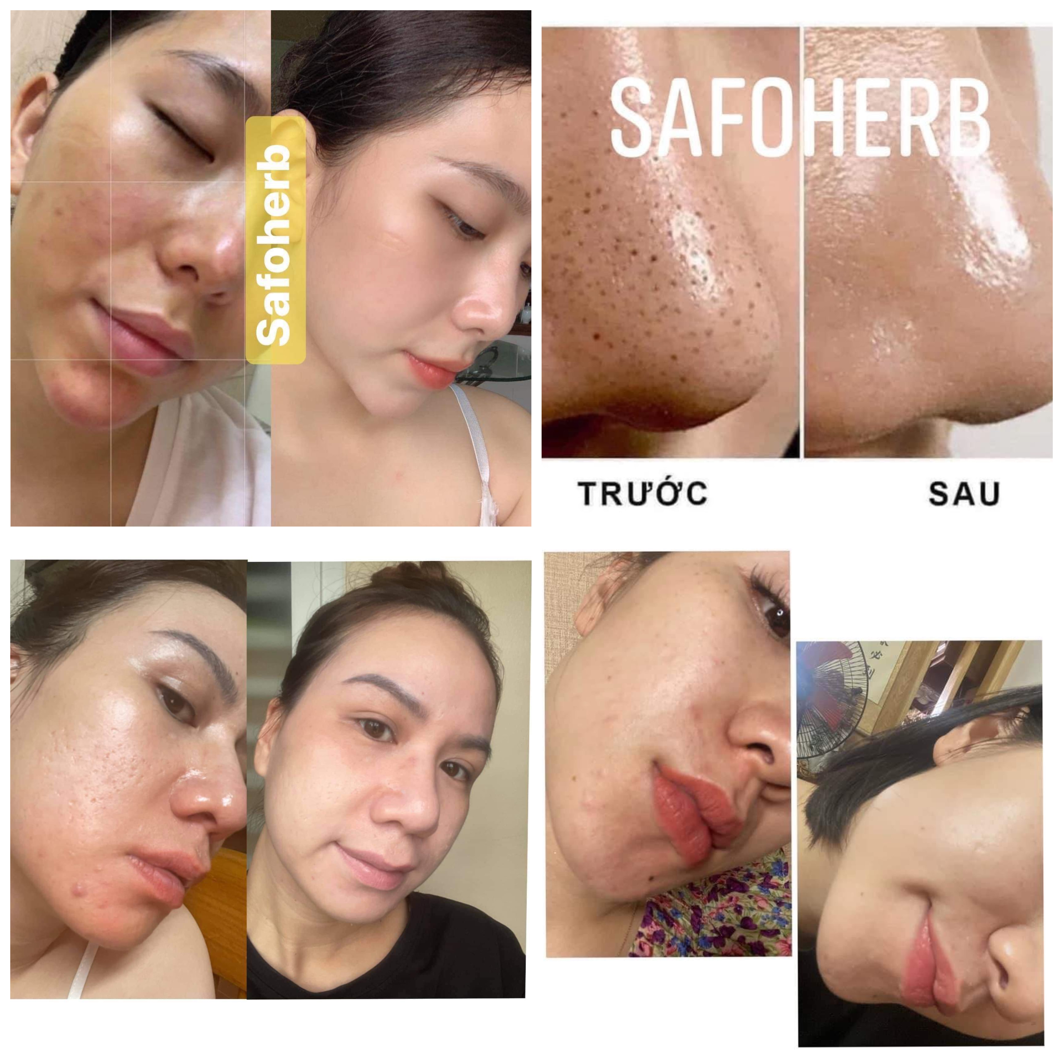 [CHÍNH HÃNG] SERUM SAFOHERB ngừa mụn mờ thâm 10ml