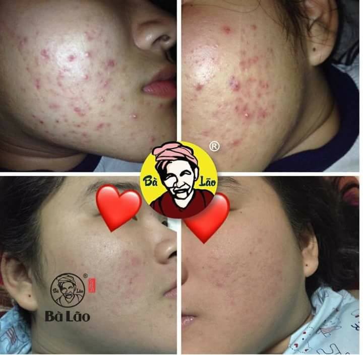 [HCM]CỰC CHẠY - BÀ LÃO CAO CẤP DÀNH CHO DA NHẠY CẢM