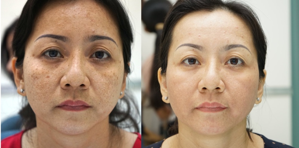 Serum nám Hoa Anh Đào 30ml