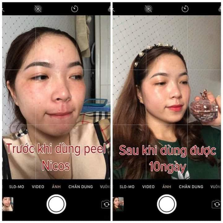 Combo giảm mụn khổ qua nhà LIM