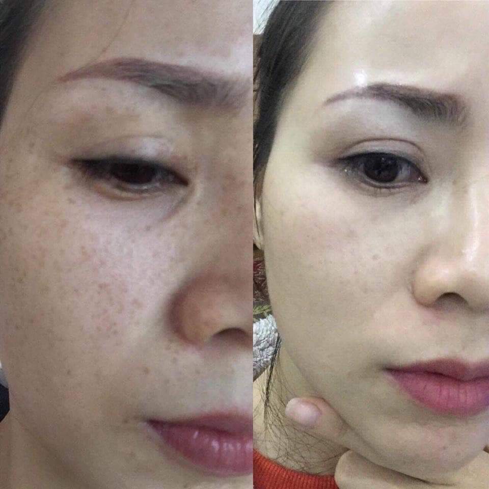 [Chính hãng] Kem Q2 COLLAGEN Nám - Tàn nhang