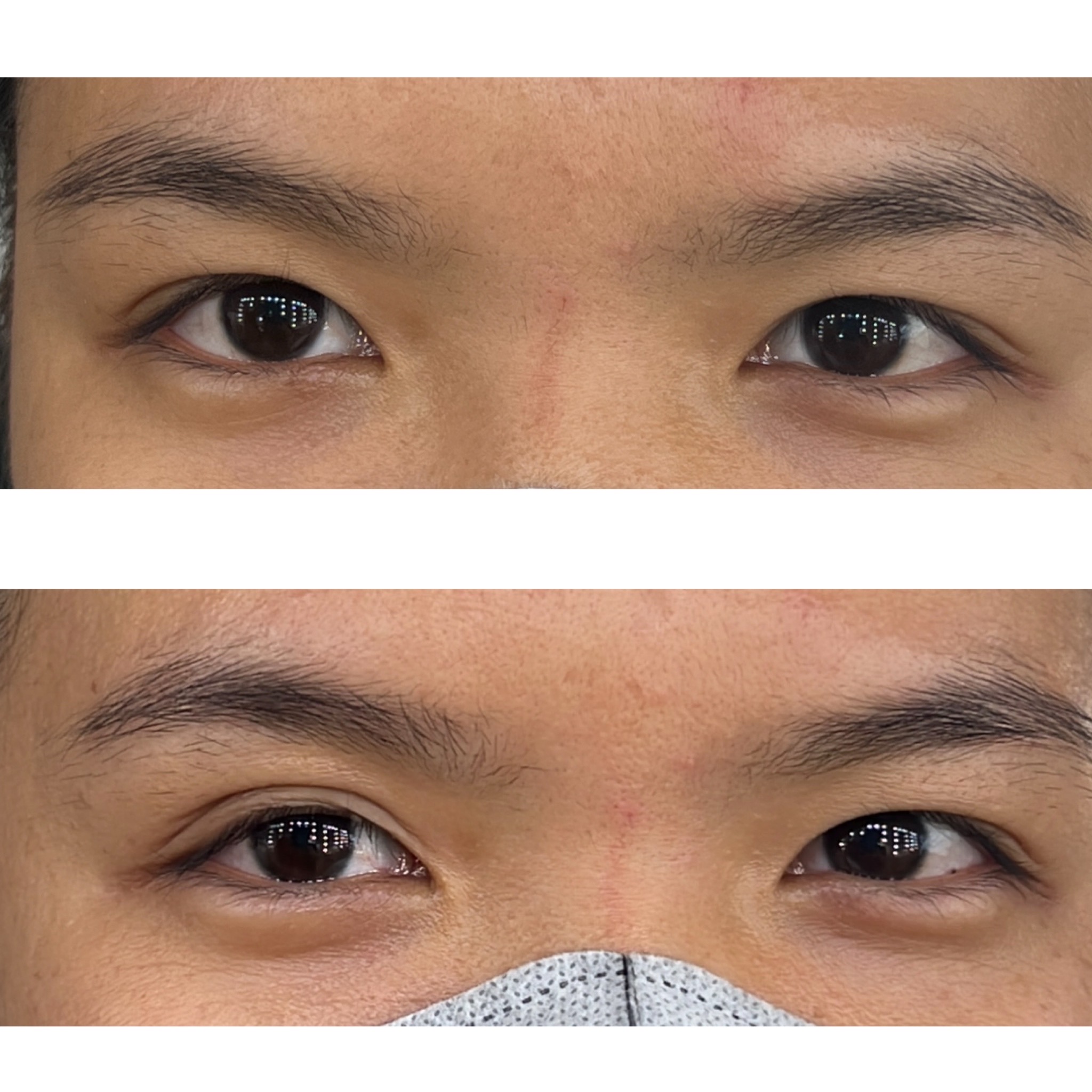 Invisible Eyelid tape ( miếng dán kích mí tàng hình)