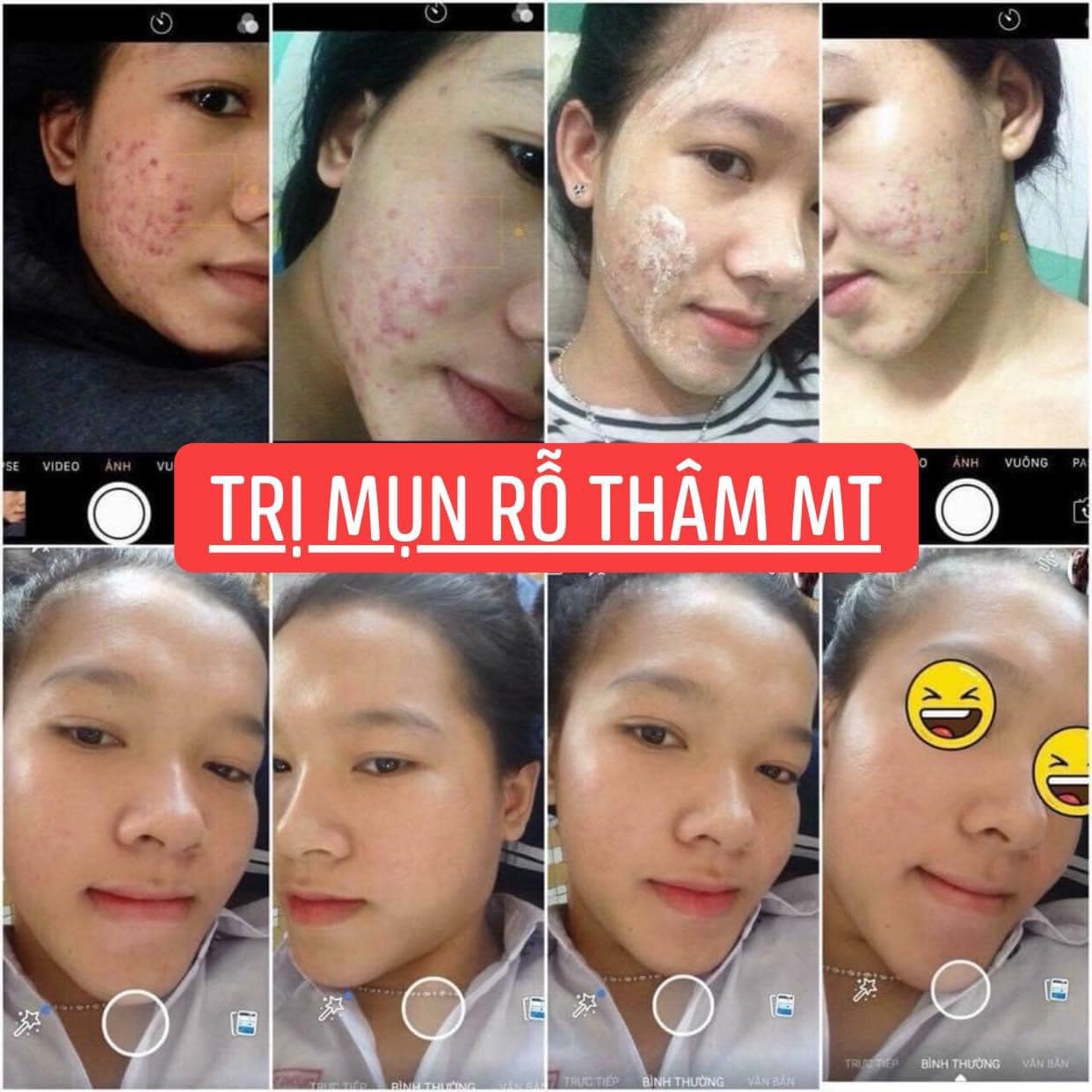 Compo 2 lọ Thảo Dược Sạch Mụn MT (100ml)