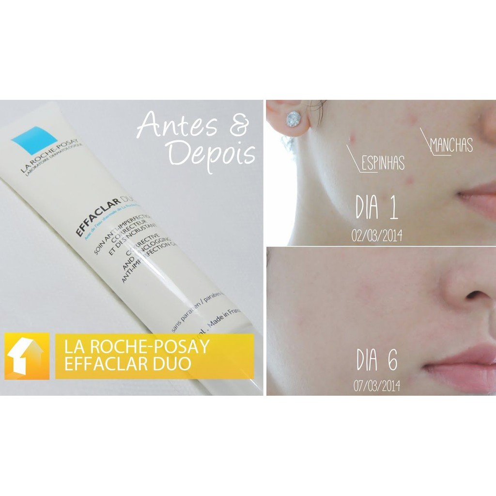 La Roche-Posay Duo+ - Kem Mụn Thần Thánh 40ml