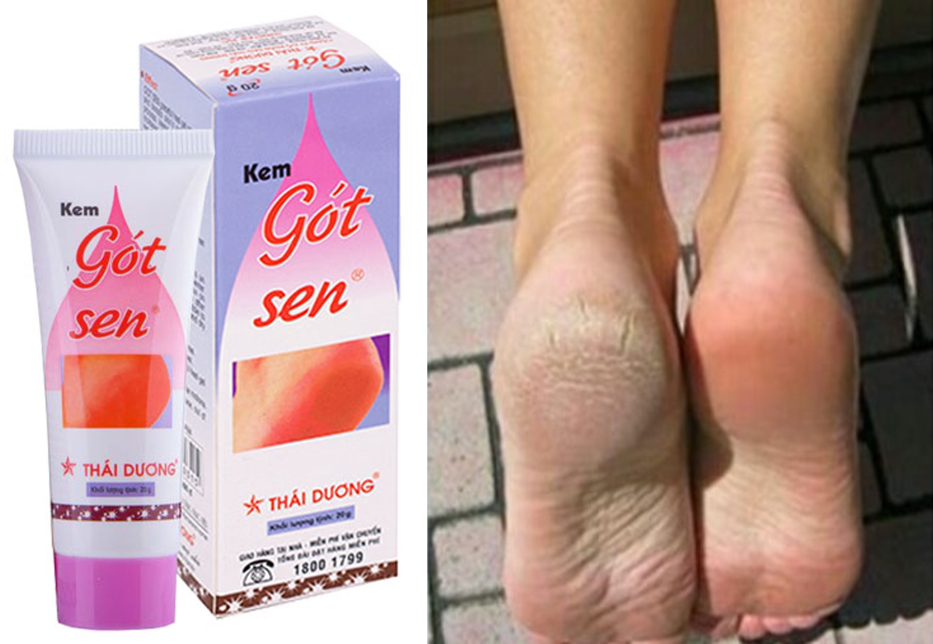 Kem Gót Sen Thái Dương - Tuýp 20g