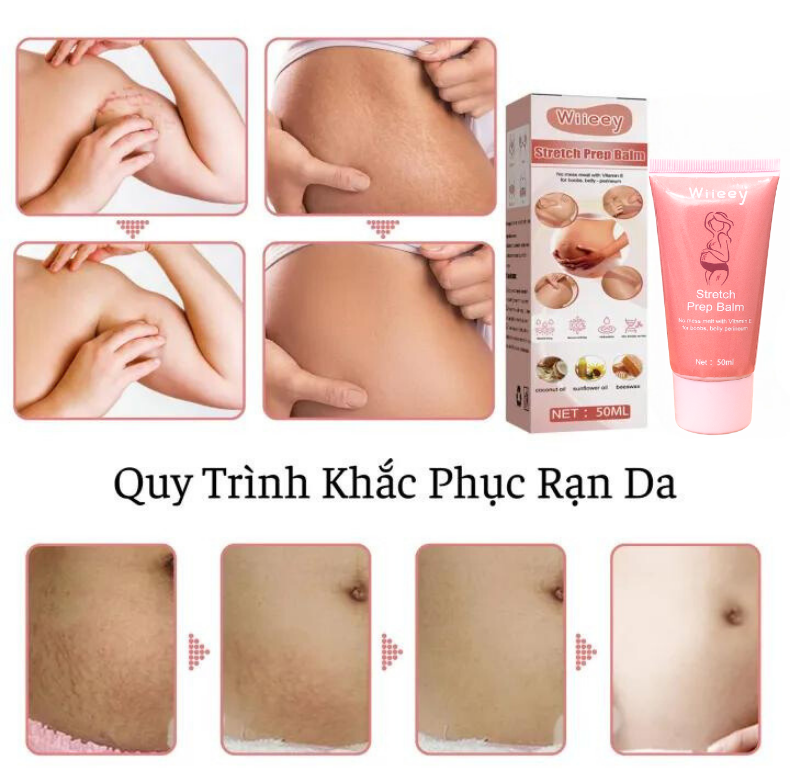 Kem Trị Rạn Da Sau Sinh Cho Bà Bầu Wiieey Cải Thiện Nếp Nhăn, Phục Hồi Độ Đàn Hồi Cho Da, Giữ Làn Da Mịn Màng Tươi Trẻ