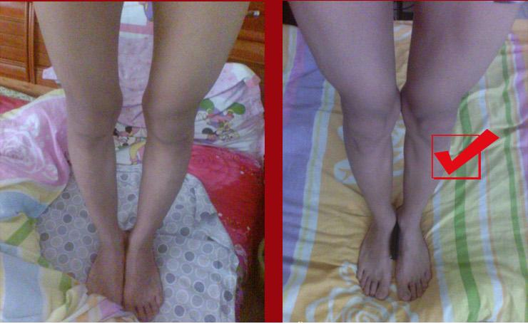 [HCM]ĐAI NẮN CHÂN VÒNG KIỀNG│Cực kỳ hiệu quả