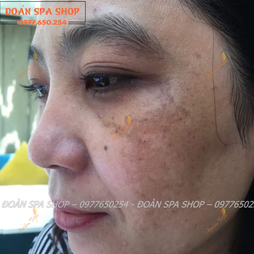 Bộ Phân Hủy Nám Luxury DevaCell - Deva cell