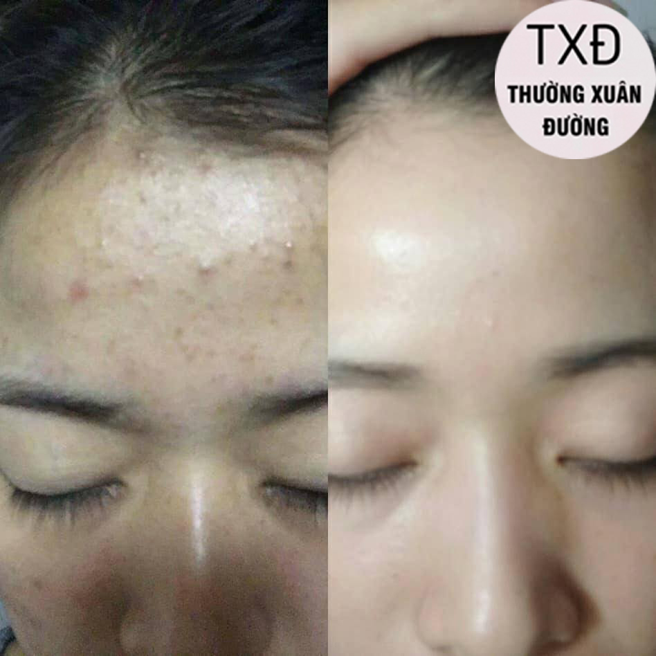 Kem Mụn Hoa Đào Hổ Trợ Cải Thiện Mụn, Thâm, Dưỡng Trắng Da