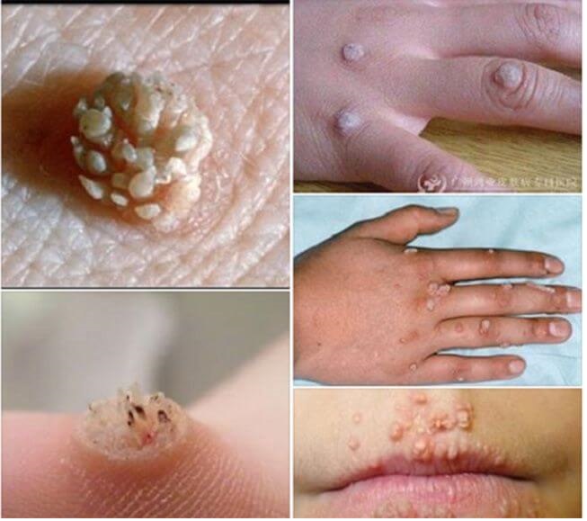 Mụn Cơm Mụn Cóc Mắt Cá Chân Vết Chai Sần