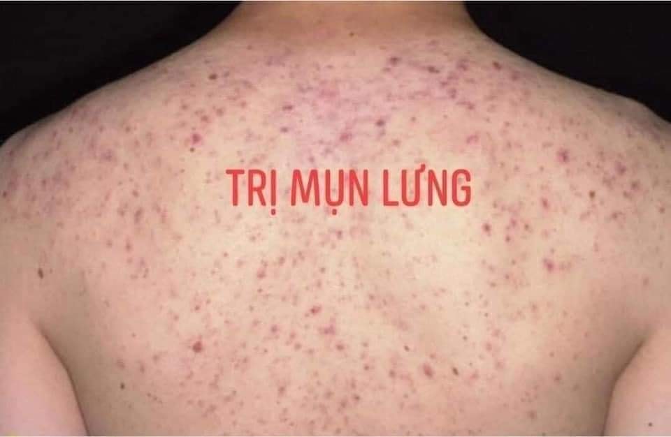 (Chuẩn Auth) Xà Phòng Loại Bỏ Mụn Lưng Tar NC Nga