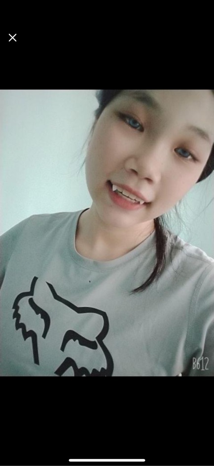 Combo răng nanh răng khểnh và keo dính