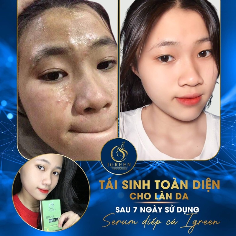 Serum Diếp Cá
