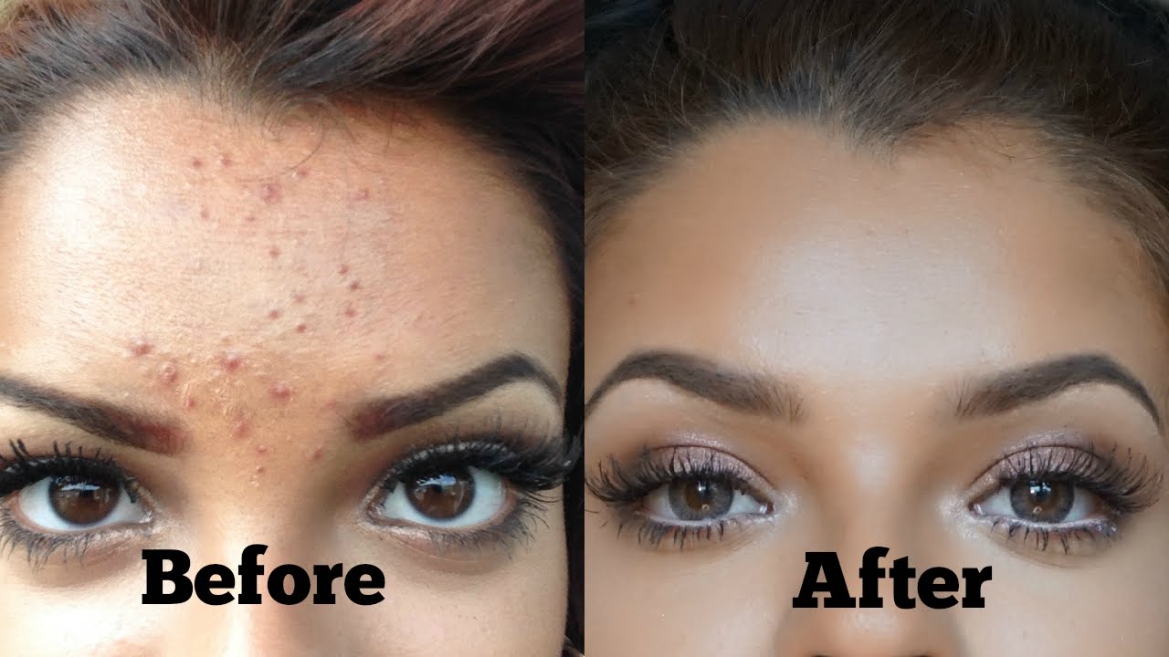 Gel Chấm Mụn Cấp Tốc T-Zone Skincare Spot Zapping Gel 8ml