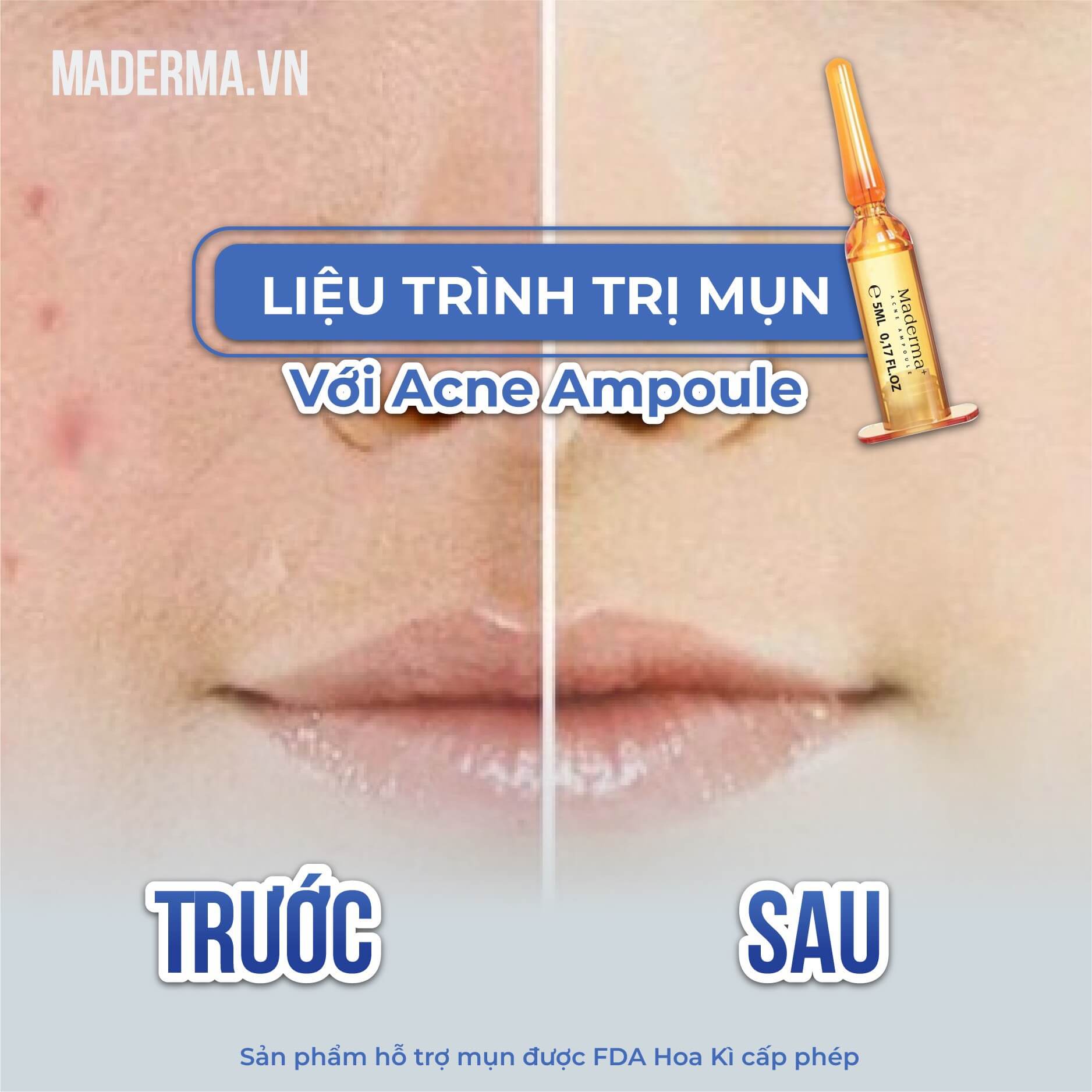 [Chính hãng]Serum giảm mụn thâm-Serum acnes ampoule Maderma+