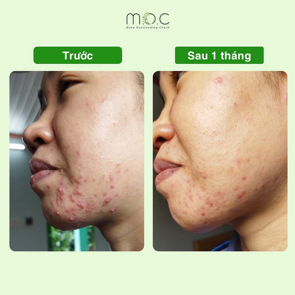 Tinh Dầu Chấm Mụn Viêm M.O.C gom nhân sau 48h