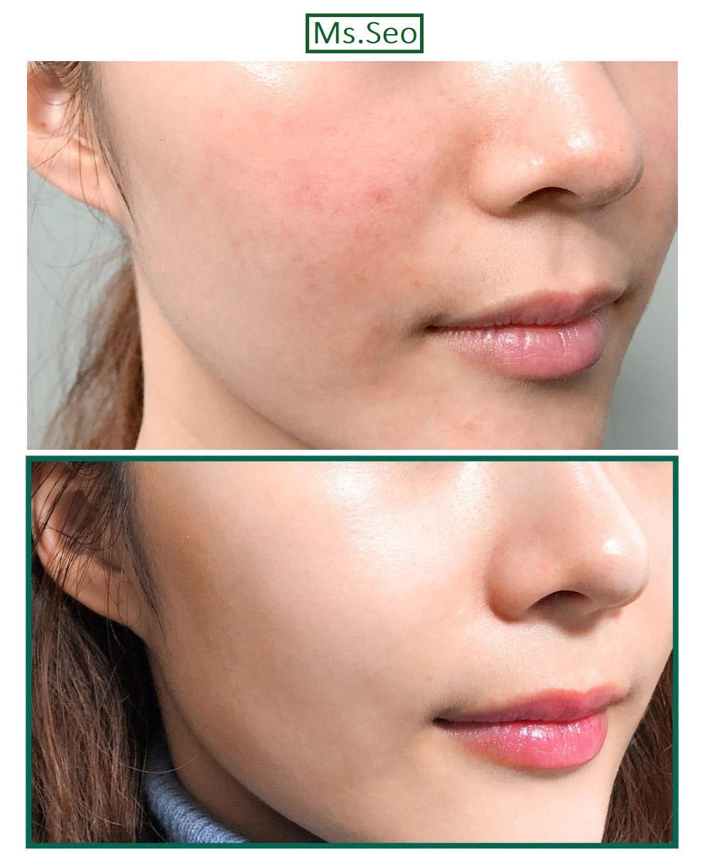 Some By Mi AHA-BHA-PHA 30 Days Miracel Acne Clear Foam 100ml