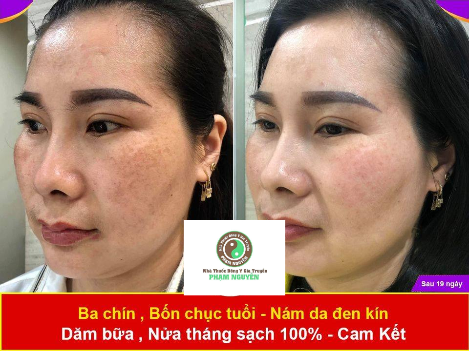 Serum trắng và chăm sóc da, Nước Cốt sâm nám Tàn Nhang