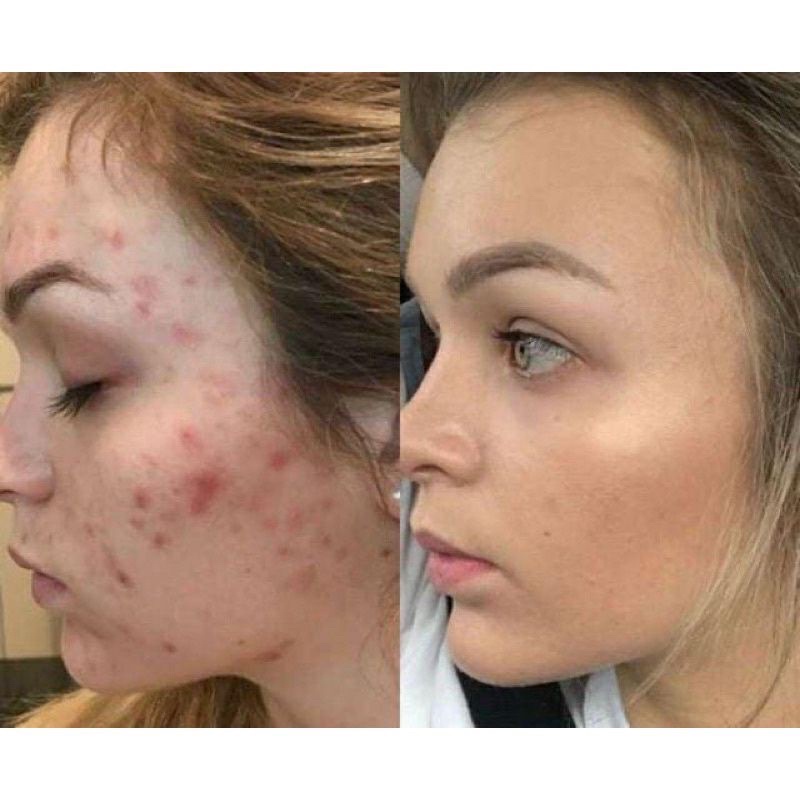 gel bôi mụn trứng cá erylik
