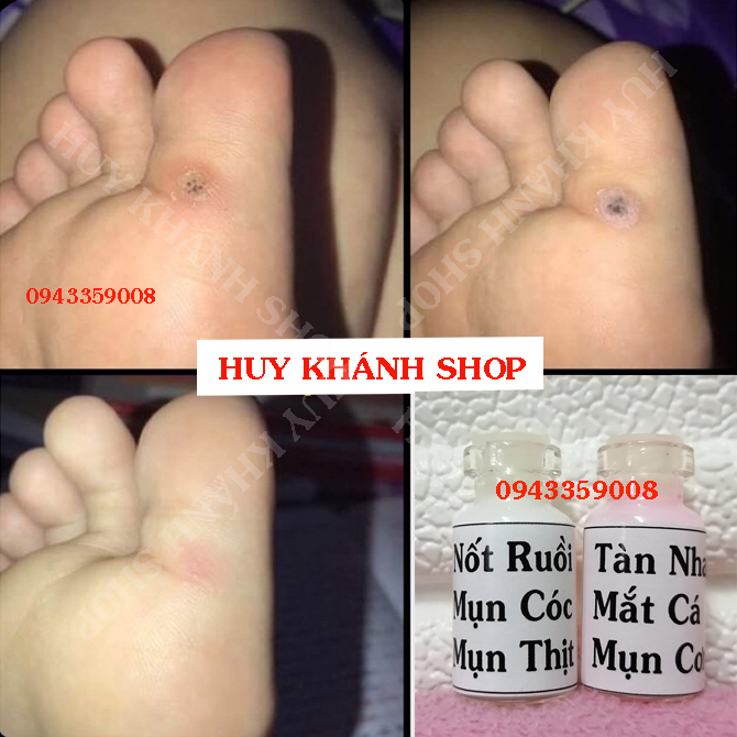 Tẩy Nốt Ruồi Tàn Nhang, Mắc Cá,Mụn Thịt, Mụn Cóc