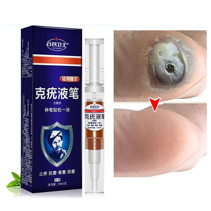 Bút lỏng trị mụn Hechuang Weishi Ke để loại bỏ gai thịt và mụn cóc, kem sửa chữa bàn tay, khỉ và bàn chân